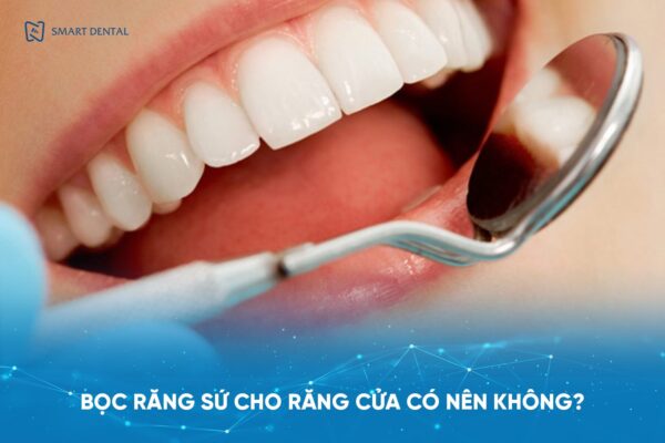 Bọc răng sứ cho răng cửa có nên không, có hiệu quả không? 2 Bọc răng sứ cho răng cửa có nên không, có hiệu quả không? 2