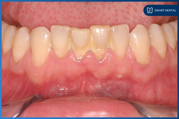Lấy cao răng có đau không 1 Lấy cao răng có đau không 1