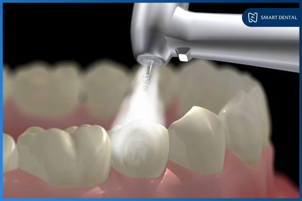 Lấy cao răng có đau không 2 Lấy cao răng có đau không 2