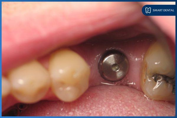 Phục hình răng sứ trên implant 2