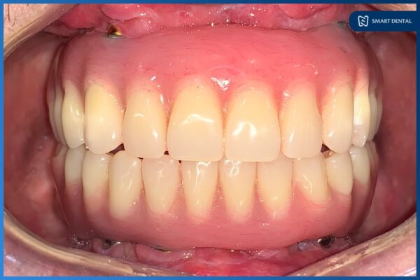 Chú Nguyễn Trung Kiên - Cấy ghép implant nguyên hàm All-on-4 2 hàm 10