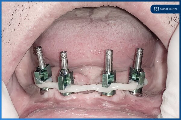 Chú Nguyễn Trung Kiên - Cấy ghép implant nguyên hàm All-on-4 2 hàm 9