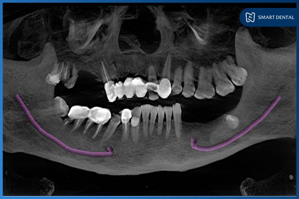 Khách hàng cấy ghép implant 2