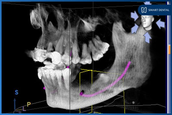 Khách hàng cấy ghép implant 3