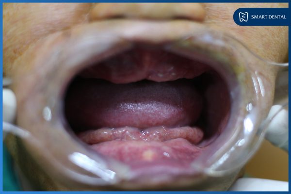 Chú Nguyễn Trung Kiên - Cấy ghép implant nguyên hàm All-on-4 2 hàm 3 Chú Nguyễn Trung Kiên - Cấy ghép implant nguyên hàm All-on-4 2 hàm 3