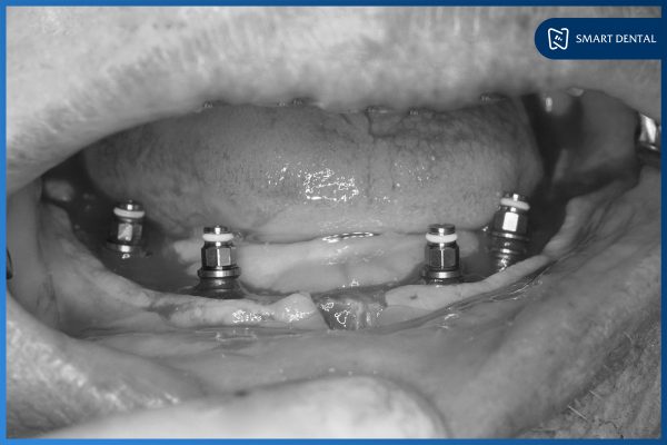 Chú Nguyễn Trung Kiên - Cấy ghép implant nguyên hàm All-on-4 2 hàm 5 Chú Nguyễn Trung Kiên - Cấy ghép implant nguyên hàm All-on-4 2 hàm 5