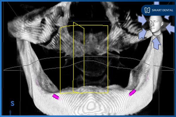 Chú Nguyễn Trung Kiên - Cấy ghép implant nguyên hàm All-on-4 2 hàm 2 Chú Nguyễn Trung Kiên - Cấy ghép implant nguyên hàm All-on-4 2 hàm 2