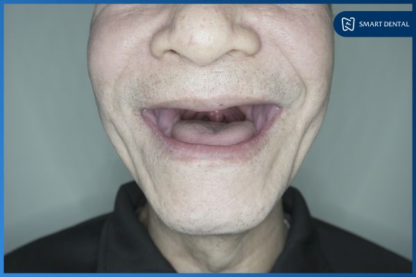 Có nên trồng răng Implant 4