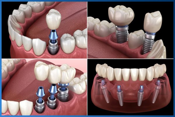 Có nên trồng răng Implant 6