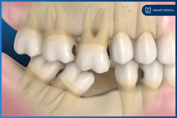 Có nên trồng răng Implant 8