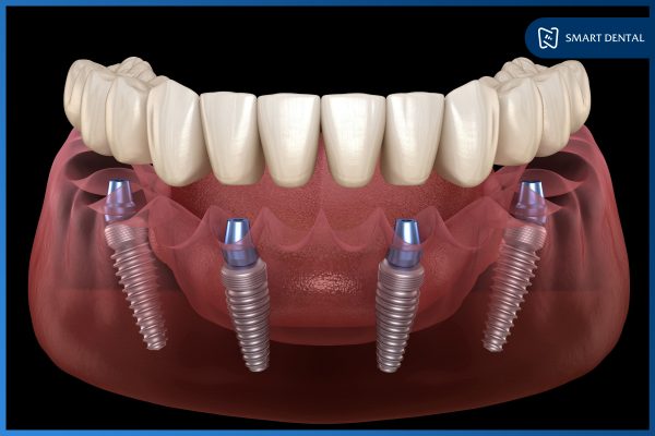 Trồng răng Implant nguyên hàm 2