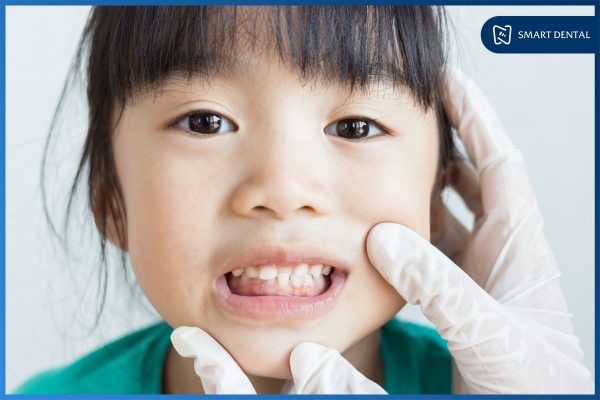Niềng răng trẻ em 2 Niềng răng trẻ em 2