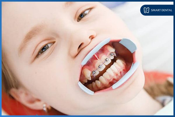Niềng răng trẻ em 4 Niềng răng trẻ em 4