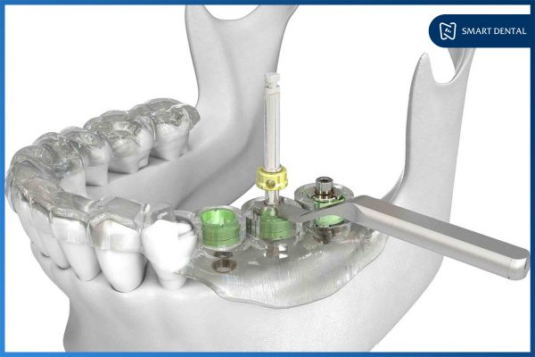 Trồng răng Implant bao lâu thì lành 2