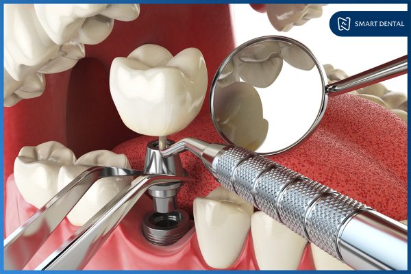 Trồng răng Implant có nguy hiểm không 1