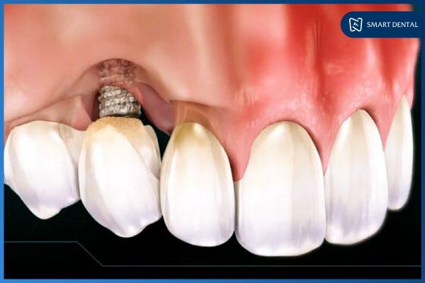 Trồng răng Implant giá rẻ 6