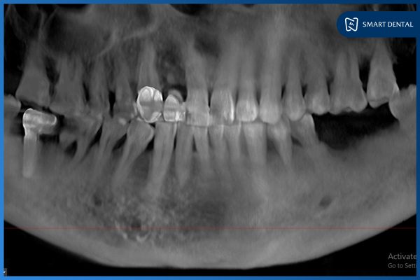 Cấy ghép thành công 2 trụ Implant Hàn Quốc - Chú Chu Văn Tiến 75 tuổi 4