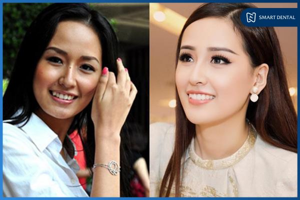 trước và sau khi niềng răng 4 trước và sau khi niềng răng 4