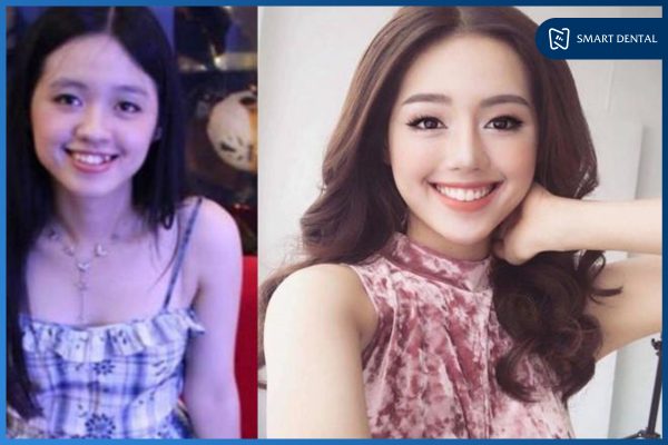 trước và sau khi niềng răng 5 trước và sau khi niềng răng 5