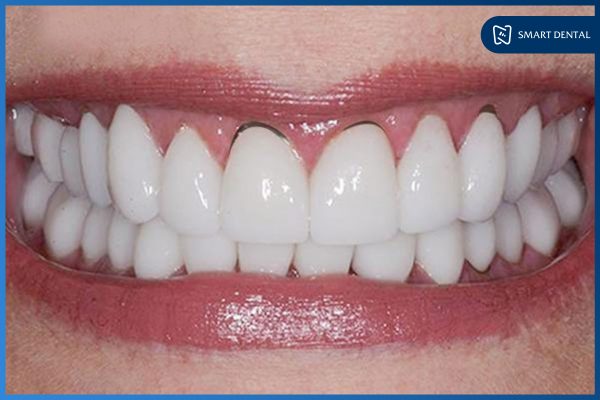 Trồng răng sứ có tháo ra được không 2 Trồng răng sứ có tháo ra được không 2