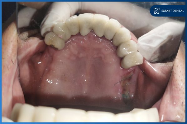 Cấy ghép thành công 6 trụ Implant tại Nha khoa Smart - Chú Ngô Xuân Tự 2