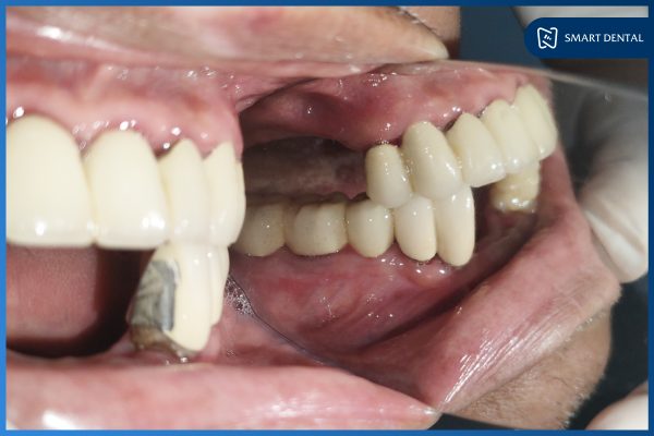 Cấy ghép thành công 6 trụ Implant tại Nha khoa Smart - Chú Ngô Xuân Tự 3