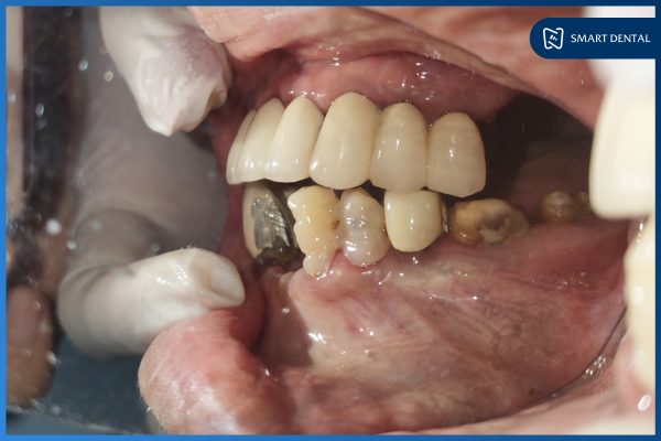 Cấy ghép thành công 6 trụ Implant tại Nha khoa Smart - Chú Ngô Xuân Tự 4