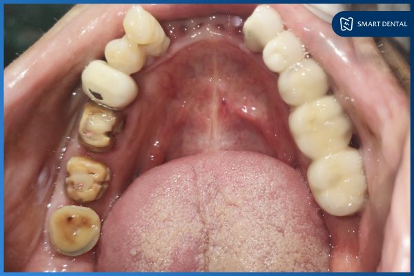 Cấy ghép thành công 6 trụ Implant tại Nha khoa Smart - Chú Ngô Xuân Tự 5 Cấy ghép thành công 6 trụ Implant tại Nha khoa Smart - Chú Ngô Xuân Tự 5