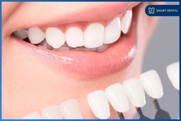Bọc răng sứ cho răng cửa có nên không, có hiệu quả không? 3 Bọc răng sứ cho răng cửa có nên không, có hiệu quả không? 3