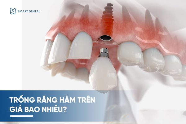 Trồng răng hàm trên giá bao nhiêu 6