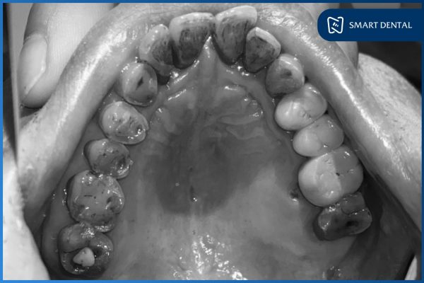 Cấy ghép 3 Implant giải quyết tình trạng mất răng cho chú Nguyễn Văn Bảo 2