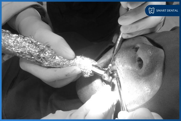 Chú Nguyễn Văn Bút - Cấy ghép 3 trụ Implant tại Nha khoa Smart 6 Chú Nguyễn Văn Bút - Cấy ghép 3 trụ Implant tại Nha khoa Smart 6