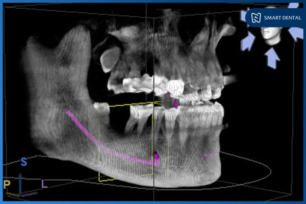 Chú Nguyễn Văn Bút - Cấy ghép 3 trụ Implant tại Nha khoa Smart 2 Chú Nguyễn Văn Bút - Cấy ghép 3 trụ Implant tại Nha khoa Smart 2