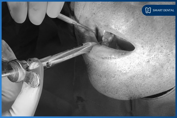 Chú Nguyễn Văn Bút - Cấy ghép 3 trụ Implant tại Nha khoa Smart 5