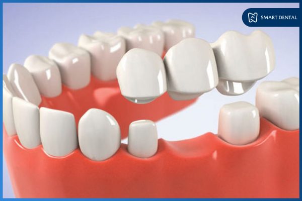 Trồng răng vĩnh viễn bằng phương pháp nào an toàn & hiệu quả? 2 Trồng răng vĩnh viễn bằng phương pháp nào an toàn & hiệu quả? 2