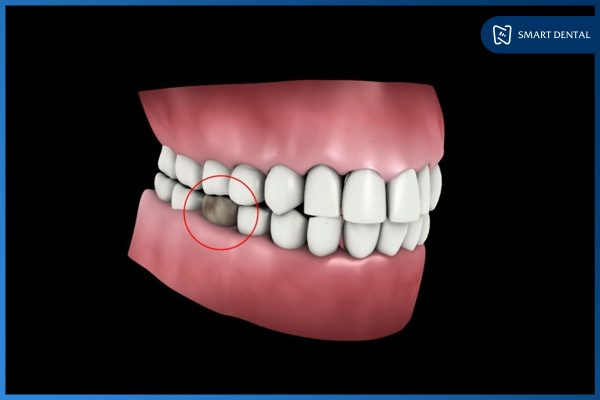 Trồng răng số 5 2 Trồng răng số 5 2