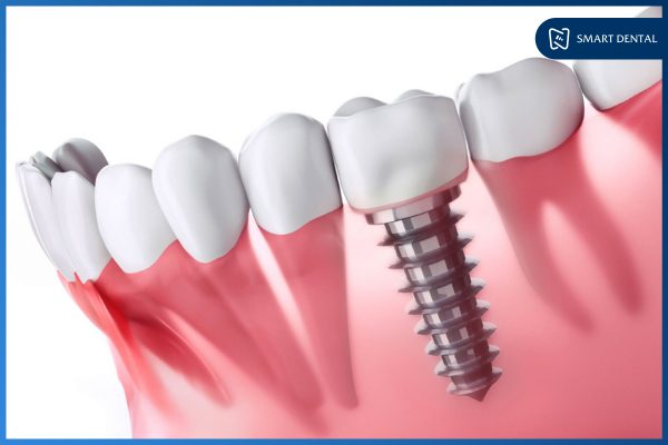 Trồng răng bằng phương pháp nào tốt nhất? Implant hay cầu răng? 4