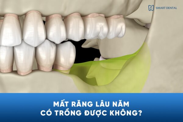 Mất răng lâu năm 4 Mất răng lâu năm 4
