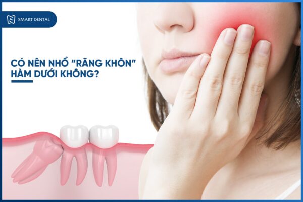 nhổ răng khôn hàm dưới 1 nhổ răng khôn hàm dưới 1