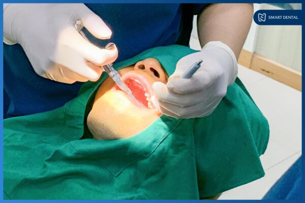 Răng khôn mọc thẳng 7 Răng khôn mọc thẳng 7