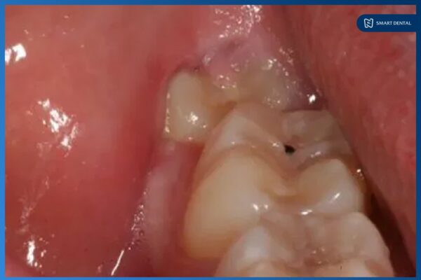 Răng khôn mọc lệch ra má 1 Răng khôn mọc lệch ra má 1