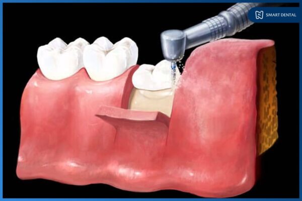 Răng khôn mọc lệch ra má 6 Răng khôn mọc lệch ra má 6