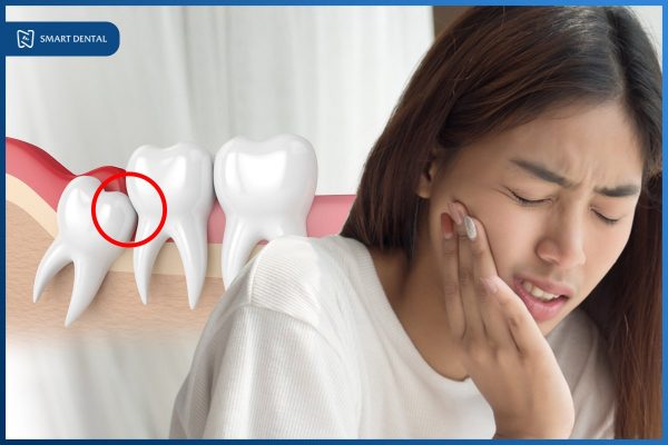 Răng khôn mọc ngầm là gì? Cách giải quyết răng mọc ngầm TRIỆT ĐỂ! 3 Răng khôn mọc ngầm là gì? Cách giải quyết răng mọc ngầm TRIỆT ĐỂ! 3