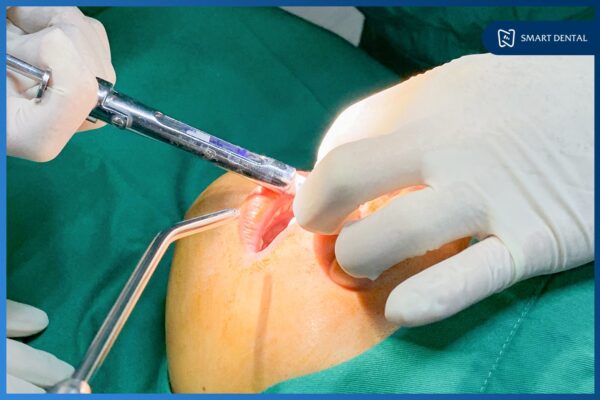 Khách hàng Trần Thùy Dương cấy 2 implant Hiossen Mỹ - Nha khoa Smart 2 Khách hàng Trần Thùy Dương cấy 2 implant Hiossen Mỹ - Nha khoa Smart 2