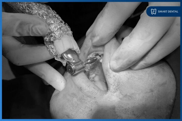 Khách hàng Trần Thùy Dương cấy 2 implant Hiossen Mỹ - Nha khoa Smart 6 Khách hàng Trần Thùy Dương cấy 2 implant Hiossen Mỹ - Nha khoa Smart 6