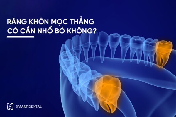 Răng khôn mọc thẳng 1 Răng khôn mọc thẳng 1