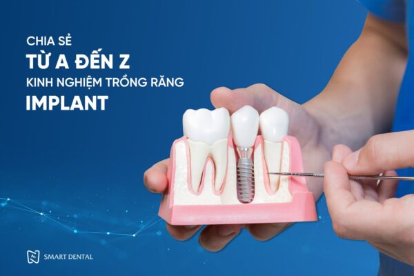 kinh nghiệm trồng răng implant 9 kinh nghiệm trồng răng implant 9