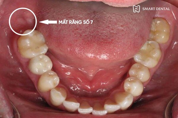 Trồng răng số 7 1 Trồng răng số 7 1