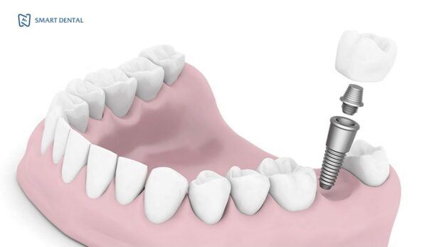 Trồng răng số 7 2 Trồng răng số 7 2