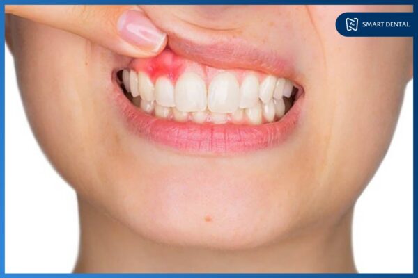 Hôi miệng 6 Hôi miệng 6